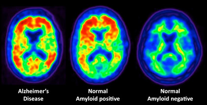 News From the PET Front: Early Amyloid Networks and Tau Mystery