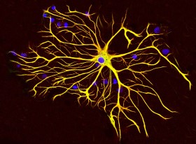 Does Astrocyte Tau Cause Dementia?