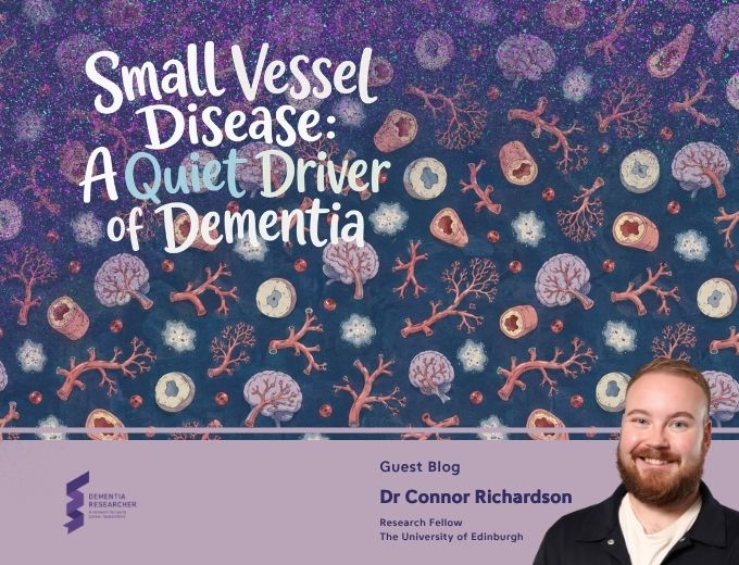 Blog – Small Vessel Disease: A Quiet Driver of Dementia